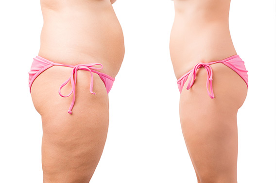 weight loss photos